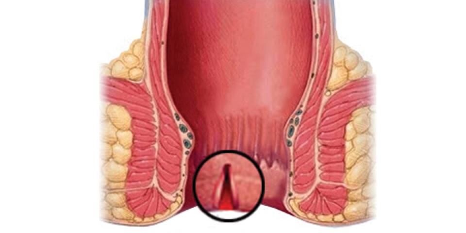 Best Anal Fissure treatment In Bangalore