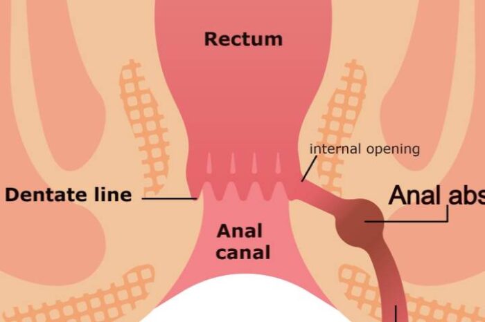 Best fistula treatment in Bangalore