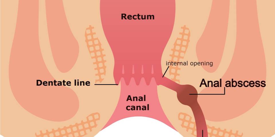 Fistula Treatment in Banagalore