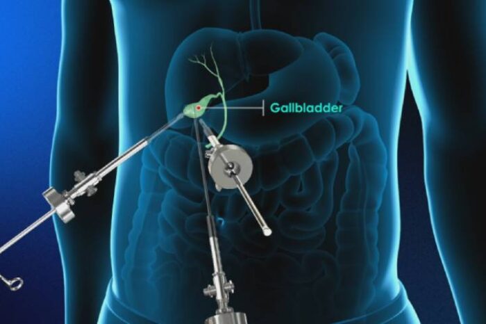 Best Gall bladder Surgeon in Bangalore