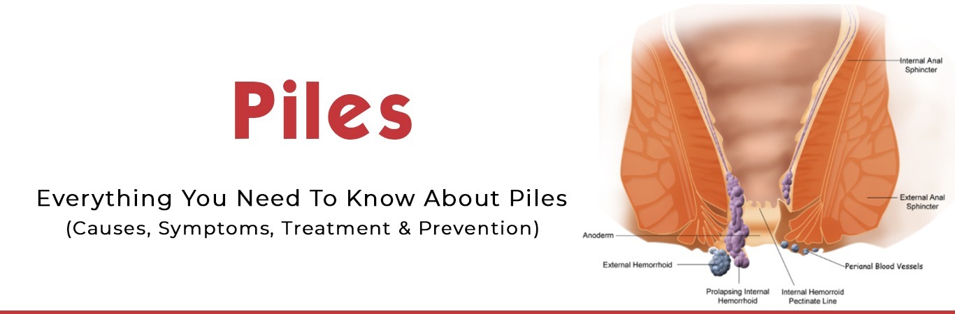 Piles treatment in Bangalore