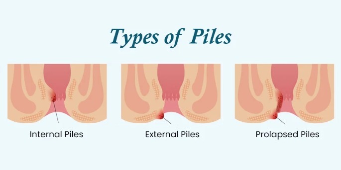 Piles treatment in Bangalore