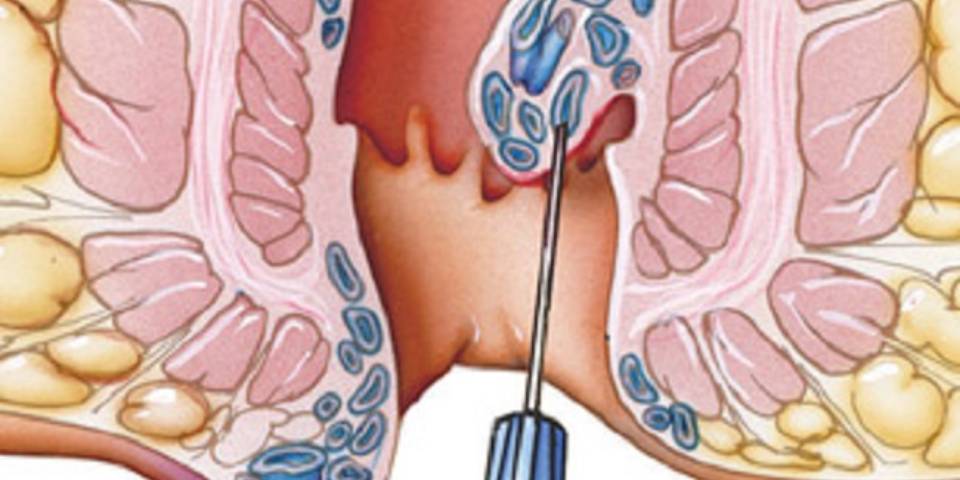 Piles Treatment