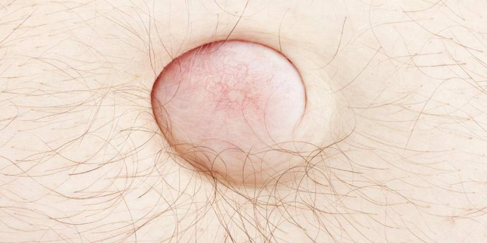 Hernia surgeon in Bangalore