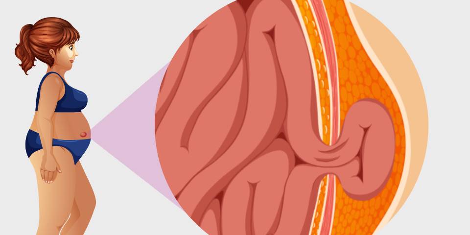 hernia treatment