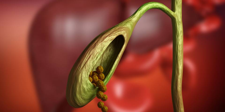 Gallstones surgery in Bangalore