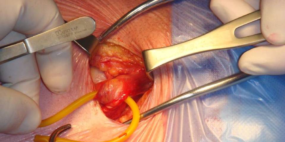 hernia