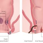 Anal Fissures vs. Hemorrhoids Understanding the Difference