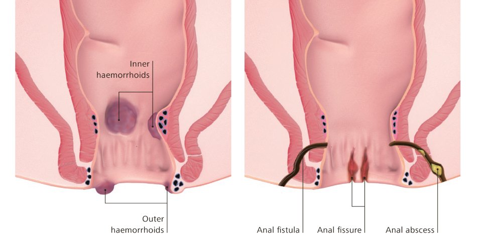 Anal Fissures vs. Hemorrhoids Understanding the Difference