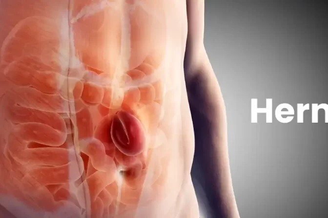 Illustration of an abdominal hernia showing a bulge through the muscle wall, representing hernia treatment in Bangalore.
