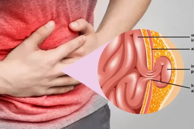 Recurrent hernia illustration showing intestinal protrusion treated by Dr. Bhushan Chittawadagi, expert in recurrent hernia treatment.