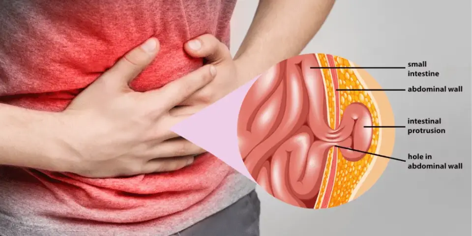 Recurrent hernia illustration showing intestinal protrusion treated by Dr. Bhushan Chittawadagi, expert in recurrent hernia treatment.