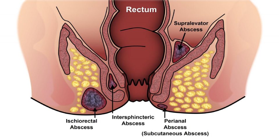 Types of abscesses in anorectal complex fistula – explained by Dr. Bhushan Chittawadagi.