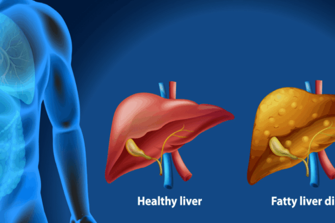 Comparison of healthy liver and fatty liver disease – by Dr. Bhushan Chittawadagi, Liver Specialist in Bangalore