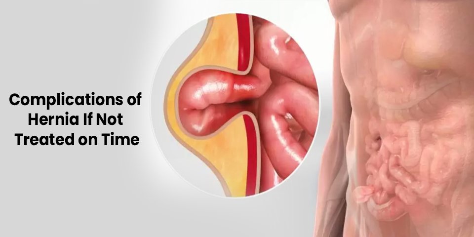 Complications of hernia if not treated on time showing intestine obstruction and abdominal bulge