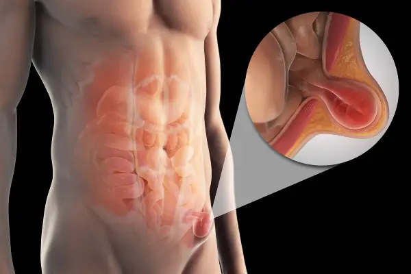 Inguinal Hernia Treatment in Chennai