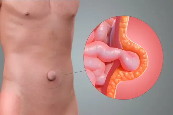 Umbilical Hernia Treatment in Bangalore