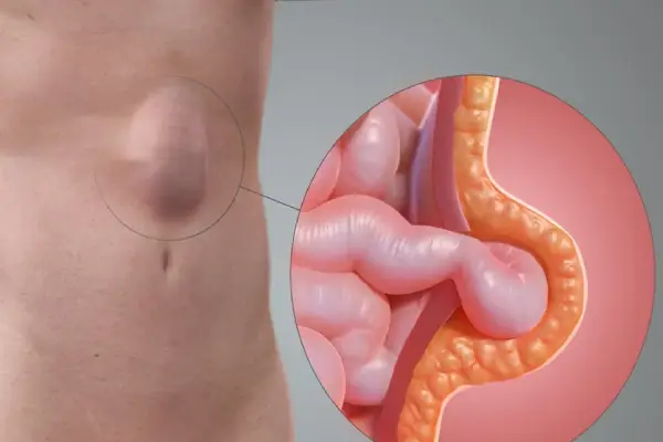 Ventral Hernia Treatment