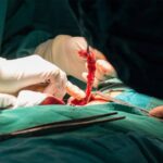 Appendix removal surgery in Bangalore by Dr. Bhushan Chittawadagi using advanced laparoscopic techniques