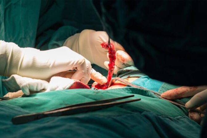 Appendix removal surgery in Bangalore by Dr. Bhushan Chittawadagi using advanced laparoscopic techniques