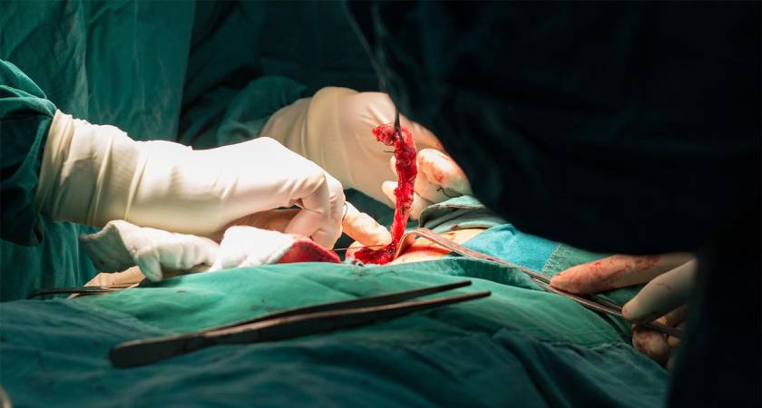 Appendix removal surgery in Bangalore by Dr. Bhushan Chittawadagi using advanced laparoscopic techniques