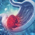 Early warning signs of digestive cancer explained by Dr. Bhushan Chittawadagi, GI Cancer Surgeon in Bangalore