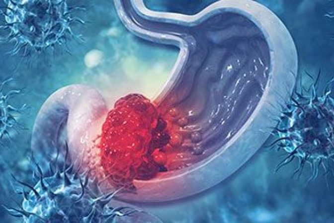 Early warning signs of digestive cancer explained by Dr. Bhushan Chittawadagi, GI Cancer Surgeon in Bangalore