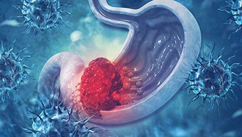 Early warning signs of digestive cancer explained by Dr. Bhushan Chittawadagi, GI Cancer Surgeon in Bangalore