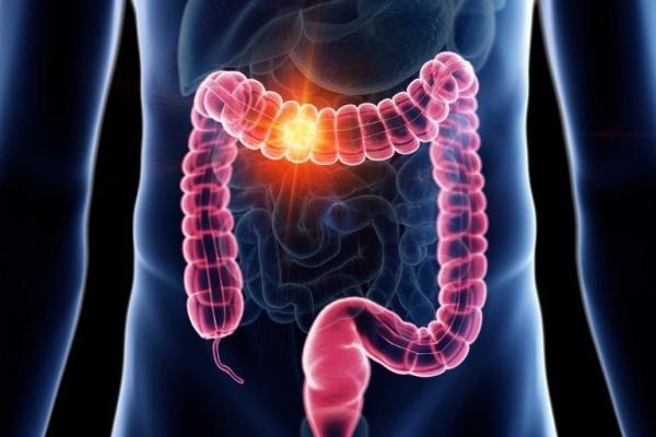 Rectal Cancer Surgeon in Bangalore Dr Bhushan Chittawadagi performing advanced laparoscopic cancer surgery