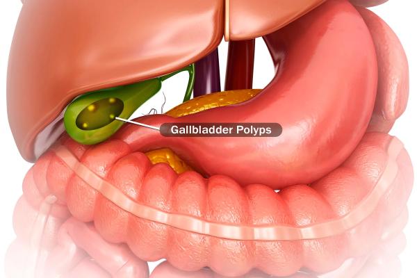 Gallbladder Polyps